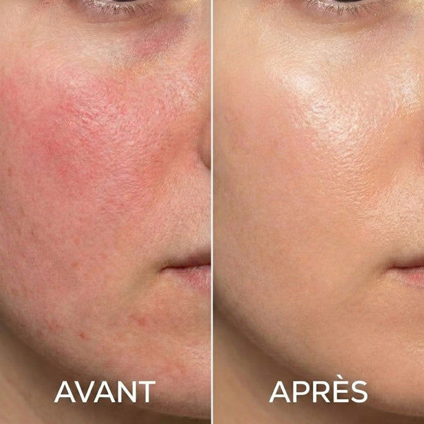 Julie B. Avant Après Rougeurs