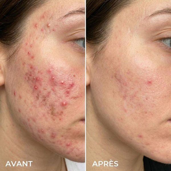 Camille R. Avant Après Cicatrisation